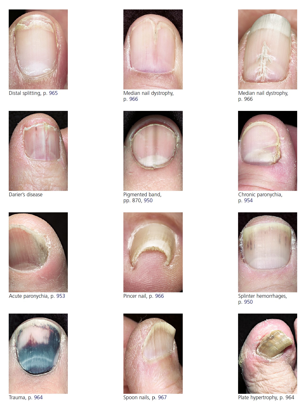 Nail As A Window of Systemic Diseases: Review Article | PDF | Nail  (Anatomy) | Psoriasis
