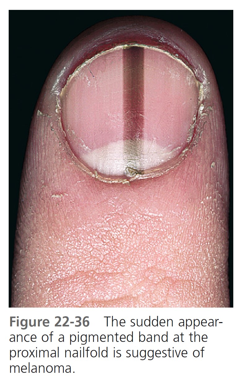Derm Dx: Discolored toenail - Clinical Advisor