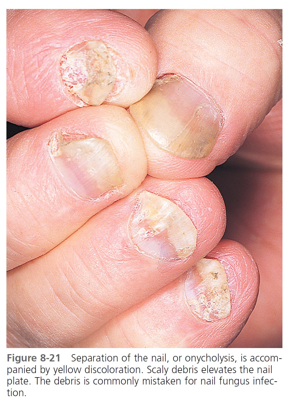 Nail Psoriasis: Diagnosis and Treatment Options — Drought Skin