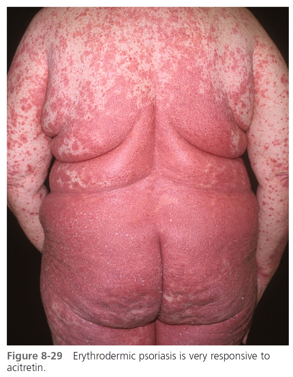 Tinea corporis (Waist and inframammary area).