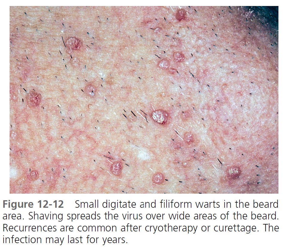 Warts, Herpes Simplex, and Other Viral Infections