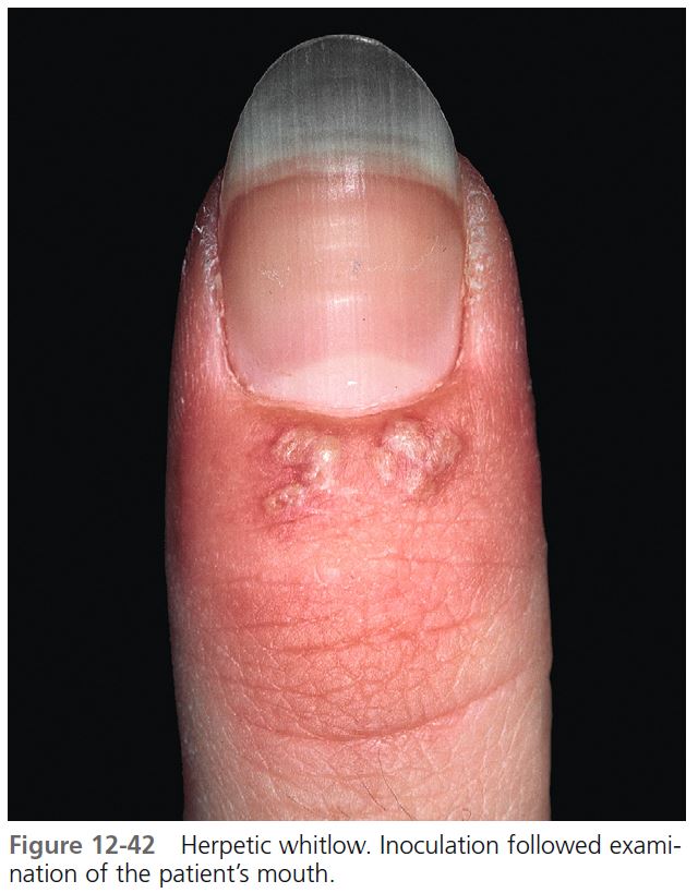 Warts, Herpes Simplex, and Other Viral Infections